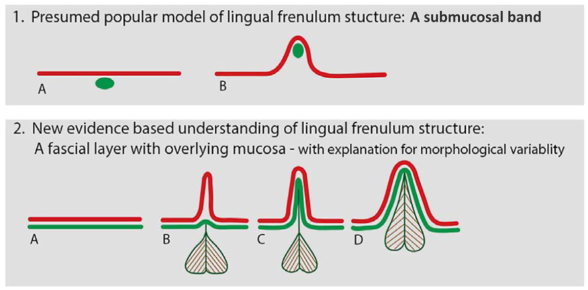 Modern peer-reviewed medical diagram of the lingual frenulum anatomy. The bottom row (panels A–D) shows how the frenulum’s morphology varies as the tongue elevates — the anatomical basis of how a tight frenulum restricts tongue movement. — Mills N, Pransky SM, Geddes DT, Mirjalili SA, Clinical Anatomy 2019;32:749–761. CC BY 4.0.