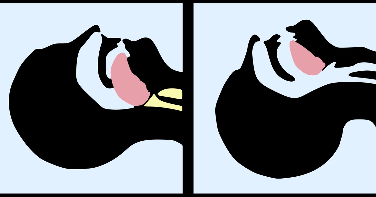 Side-profile anatomical silhouettes comparing normal vs altered adult airway anatomy — illustrating the airway structures involved in snoring and sleep apnea.